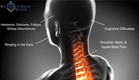 Symptoms of Whiplash | Whiplash Injury | Treatment for Whiplash