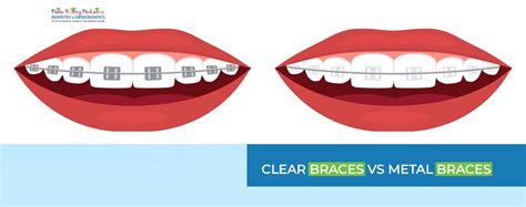 Clear Braces Costs Best Brands, Pros Cons, 57% OFF