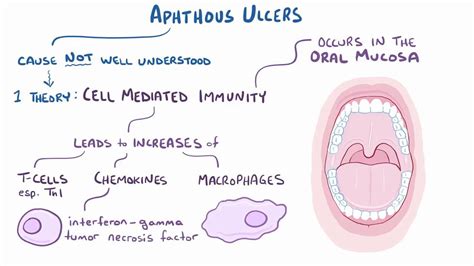 Aphthous ulcers: Video, Anatomy, Definition & Function | Osmosis