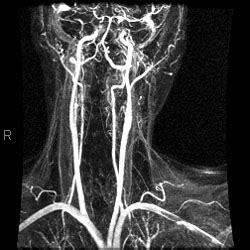 MR Angiogram - Imaging Glossary - Patients - UR Medicine Imaging ...