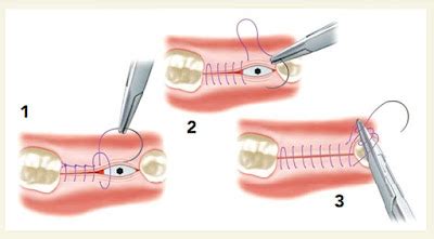 PDF: A Guide to Sutures in Oral Surgery - DENTAL LEARNING