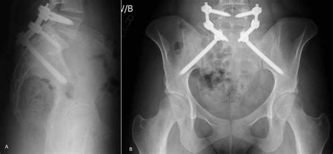 Cureus | Minimally Invasive Lumbopelvic Fixation for Unstable U-Type ...