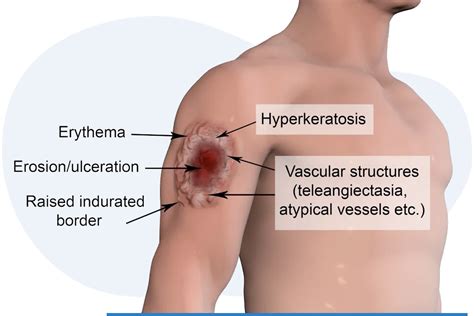 Wound Healing - Sterify