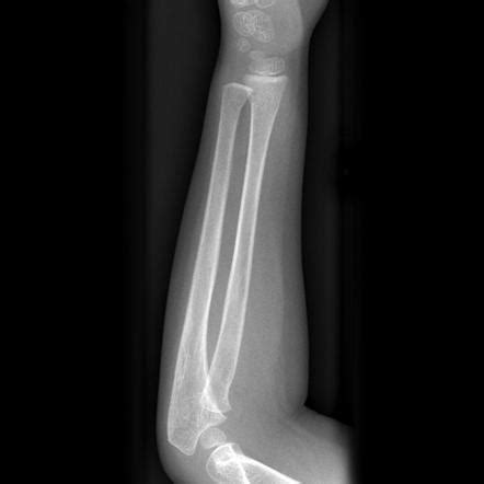 Describing a Fracture on X Ray - KarterkruwBoyd