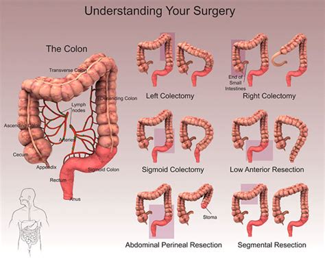 Bowel Resection – Division of General Surgery Department of Surgery