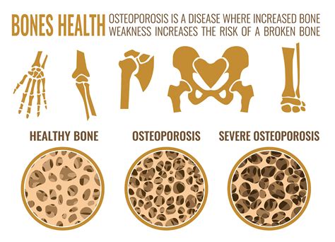 Preventing Osteoporosis