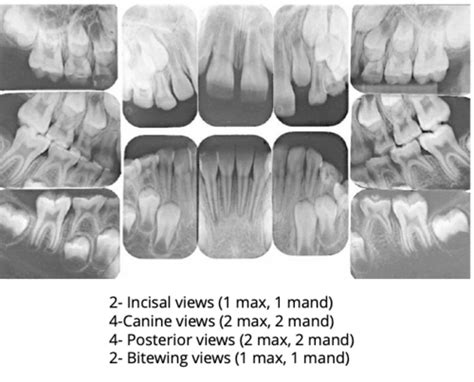 3.6 - Radiographic Interpretation: Mixed Dentition Flashcards | Quizlet