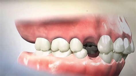 Removing Teeth for Braces - What Happens During Extraction and ...