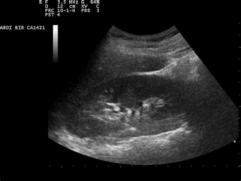 Kidney Ultrasound