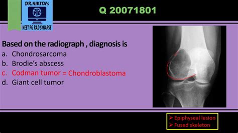 Differentiating epiphyseal lesions- Chondroblastoma vs Giant cell tumor ...