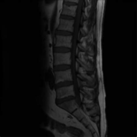 L5/S1 disc extrusion | Image | Radiopaedia.org