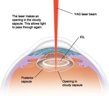 Yag Laser Eye Surgery | Yag Laser Capsulotomy - Snead Eye Group