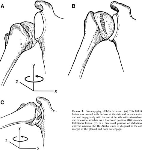 Hill-Sachs Lesion | Semantic Scholar