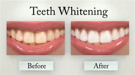 Does Teeth Whitening Work? | Klooster Family Dentistry