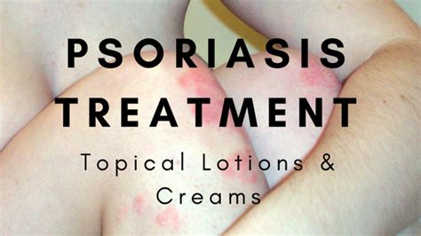 The Best Psoriasis Treatment – Topical Lotion and Cream : Reviews for ...