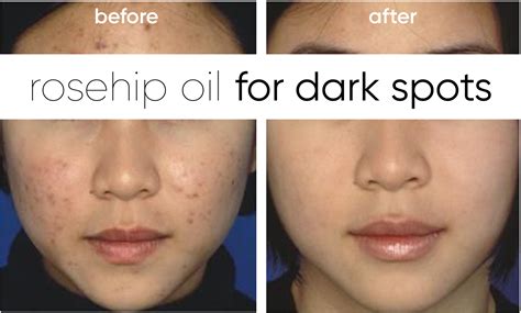 The Benefits of Rosehip Oil: Tone, Texture and Pigmentation – Mullein ...