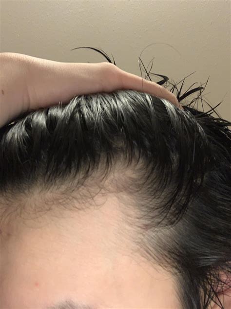 Is this a receding hairline? My left temples have recently been ...