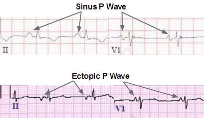 Ectopic Atrial Tachycardia Ecg