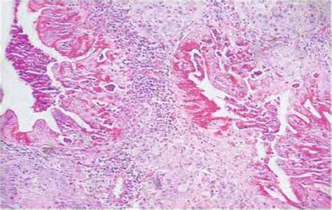 Mucoepidermoid Carcinoma [85603 - Cell Differentiation