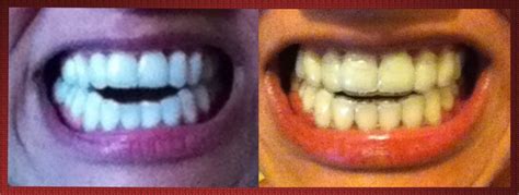 Invisalign For Severe Anterior Open Bite - My Pictures and Story: Tray ...