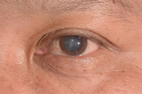 Cloudy Vision After Cataract Surgery (Post Surgery Complications)