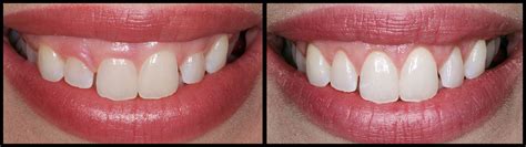 Cosmetic Dentistry Before & After Case Studies | Bunker Hill Dentistry ...