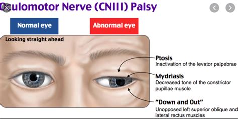 Re: Cranial Nerve III Palsy(Oculomotor nerve palsy) - 12 신경질환의 탐구 - 치료적 ...