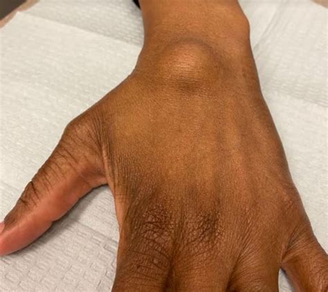 Wrist Ganglion Cyst