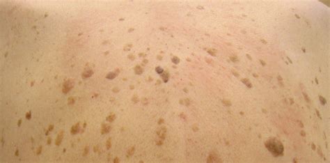 Seborrheic Keratosis FAQ - Vista Dermatology