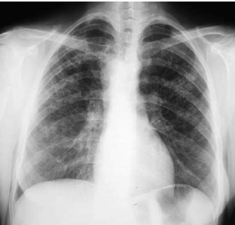 Chest X-ray of a 46 year-old patient, smoker, with pulmonary ...