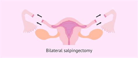 Bilateral salpingectomy