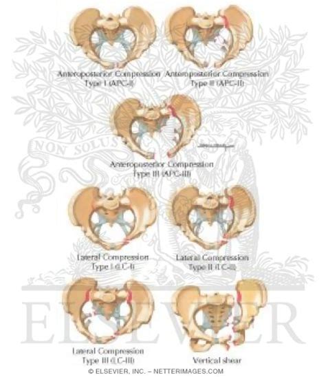 Classification of Pelvic Fractures (Young and Burgess) Trauma