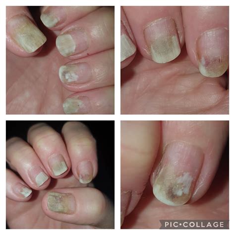 Onycholysis: Gel Nail Allergy? : r/DermatologyQuestions