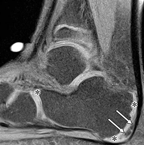 Pitfalls in MRI of the Developing Pediatric Ankle | RadioGraphics