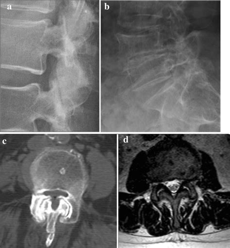 a, b, c, d Examples on LL radiograph of dorsal (a) and lumbar (b ...