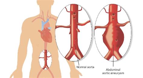 Fenestrated endovascular aneurysm repair - Norton Healthcare Provider ...