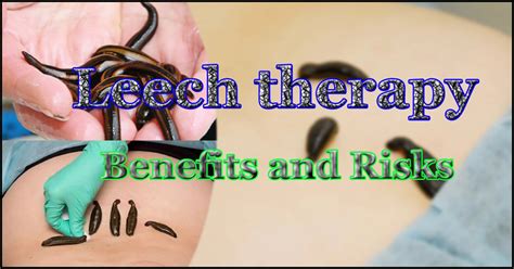 Leech therapy: Health Benefits and Risks - DaddyDontBlog