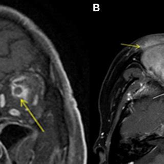 Clinical and radiological features of optic perineuritis. | Download ...