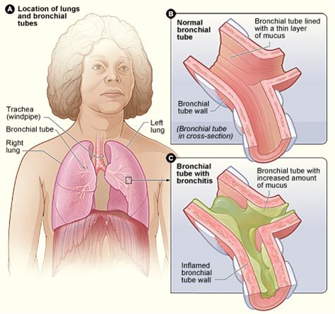 How To Cure Acute Bronchitis - Internaljapan9