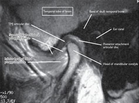 The temporomandibular joint | Pocket Dentistry