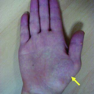 Thenar muscle atrophy in a patient with carpal tunnel syndrome. The ...