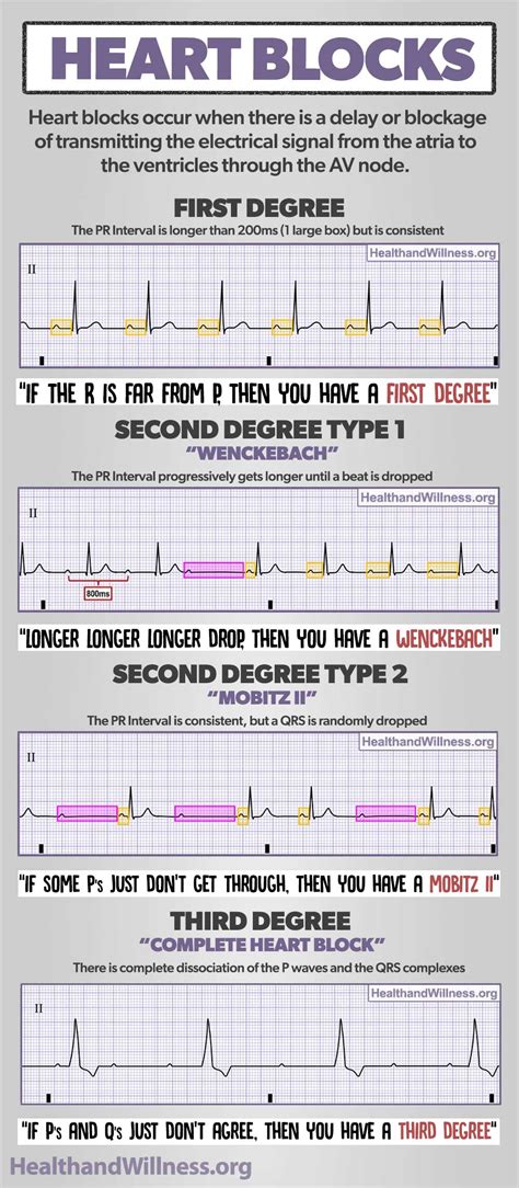 Hypokalemia Ecg Strip