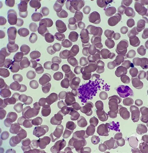 Clumps of platelets in peripheral blood smear