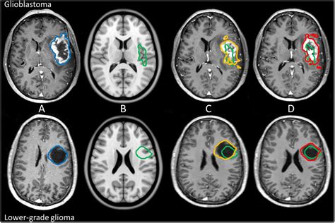 Frontiers | Accurate MR Image Registration to Anatomical Reference ...