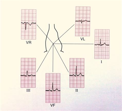 ECG (EKG) Interpretation - Oxford Medical Education