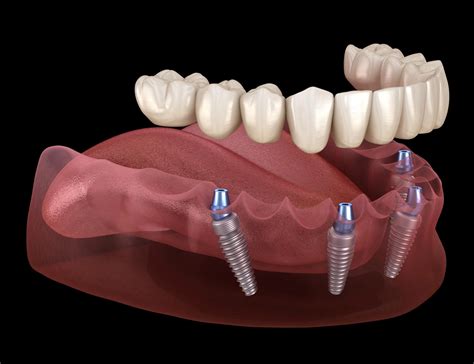 What Are The Different Dental Implants Types? - Las Vegas Cosmetic ...