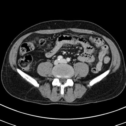 Normal Ct Scan Abdomen