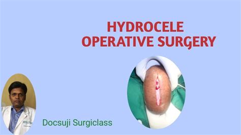 HYDROCELE OPERATIVE SURGERY - YouTube