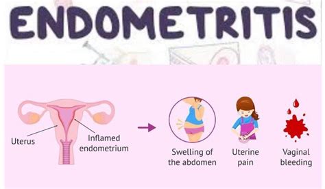 POSTPARTUM ENDOMETRITIS (Part 2) - THISDAYLIVE