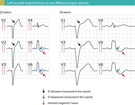 Left bundle branch block (LBBB): ECG criteria, causes, management – ECG ...